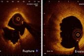 Twitter Takes on the Times of India, but the Question Persists: Is Foregoing a Stent an Option? 